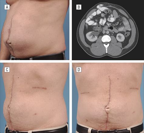 repair of anterior abdominal hernia